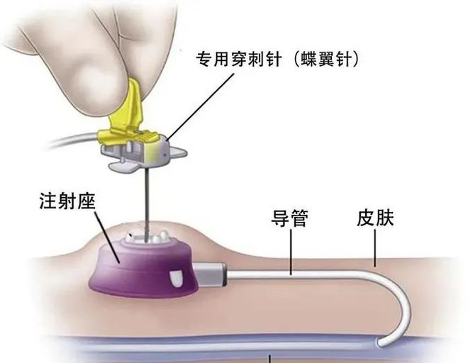 最新静脉输液流程详解